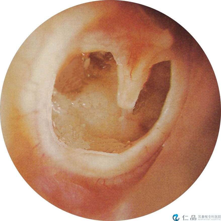 鼓膜穿孔的症状